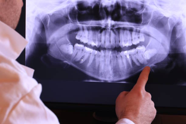 Best Emergency Tooth Extraction in Mansfield, PA